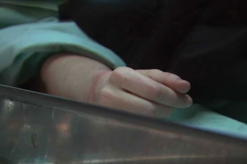 11-anyos nagpatuli, tepok sa anesthesia!